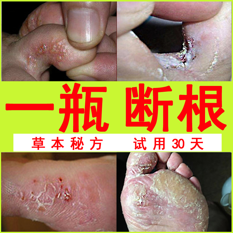 治脚气去根的药膏神器喷剂止痒脱皮偏方脚臭烂脚丫抗真菌感染外用